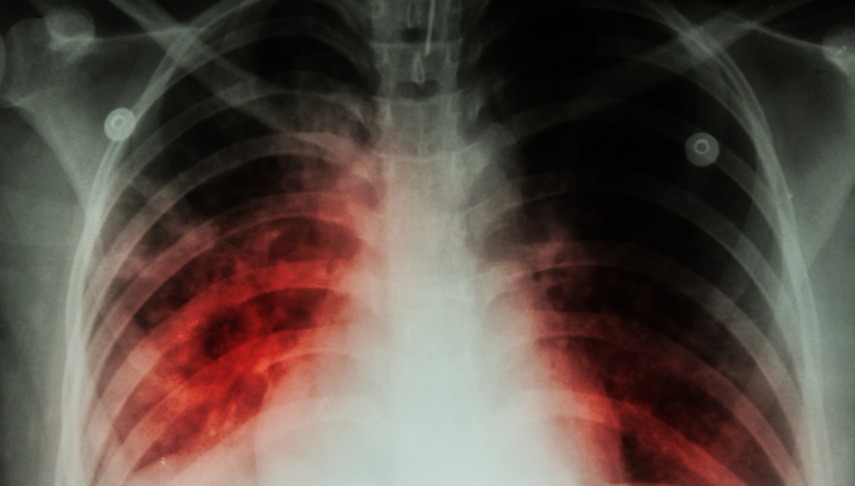 Saúde inicia busca ativa em campanha contra a tuberculose
